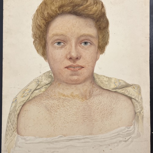 19Th Century Female Medical Skin Disease Watercolour Painting By W. Toogood Hill